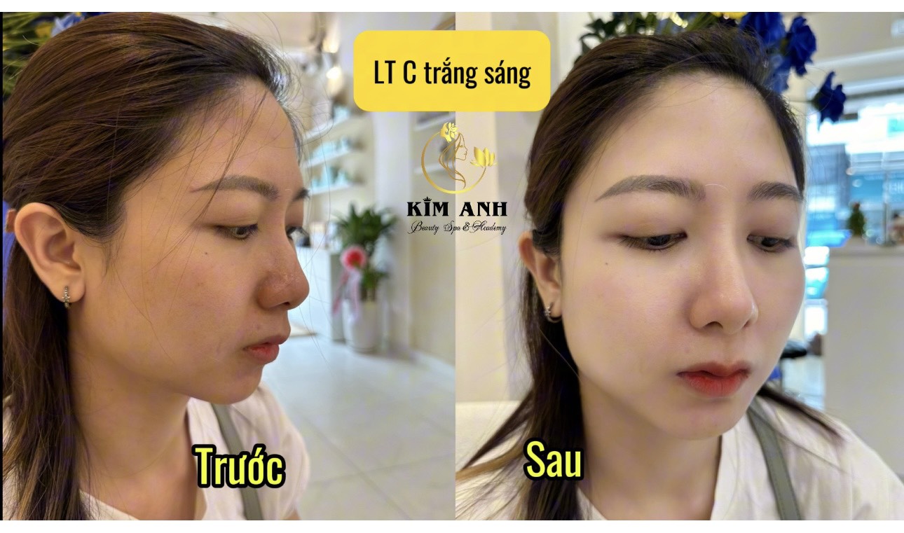 Làn da sau khi sử dụng liệu trình làm trắng của Kim Anh Spa